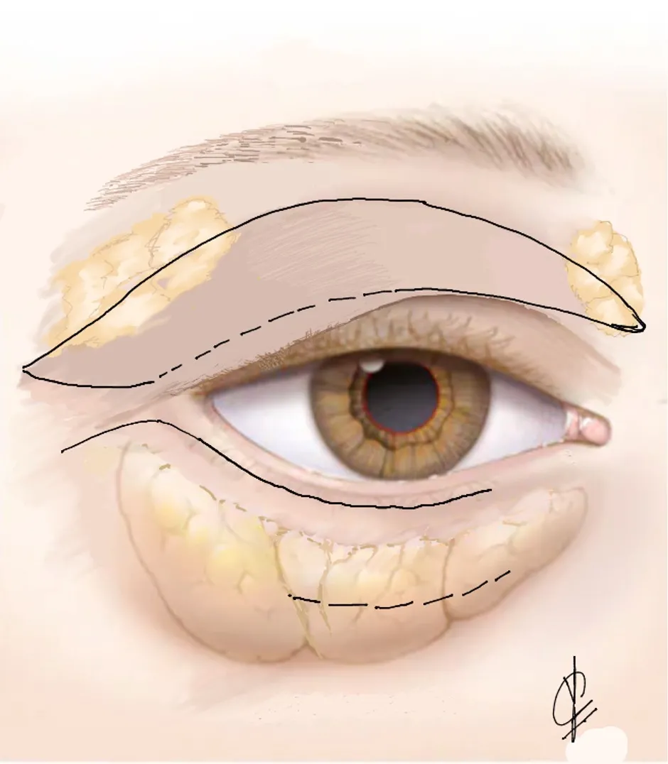 Areas ofr eyelid surgery (blepharoplasty) and periorbital rejuvenation in Adelaide.